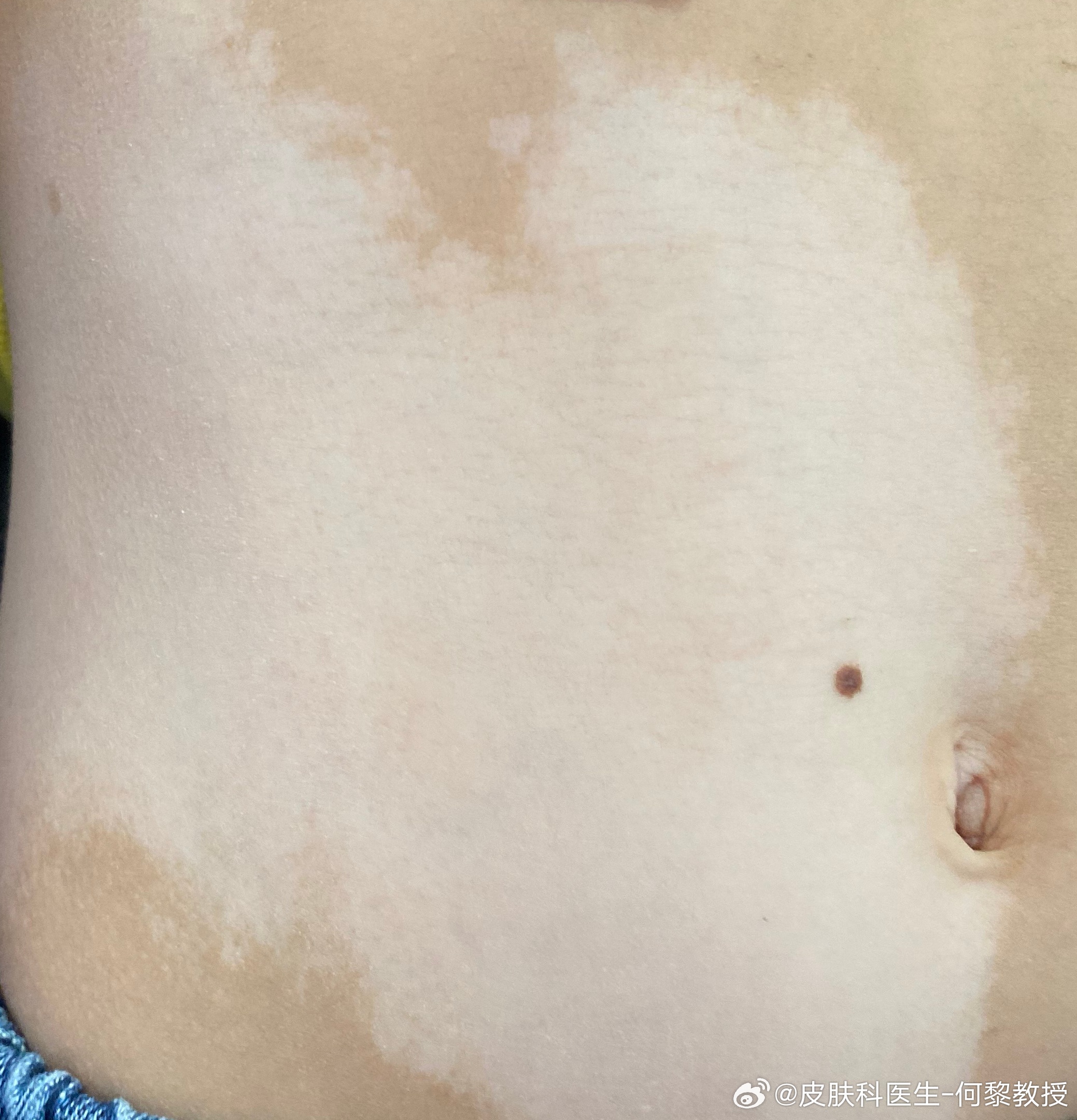 白斑治療新進(jìn)展揭秘，小巷深處的秘密小店探索之路