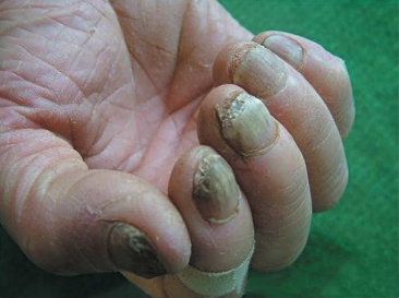 揭秘醫(yī)院治療灰指甲價格與小巷深處的特色小店探秘