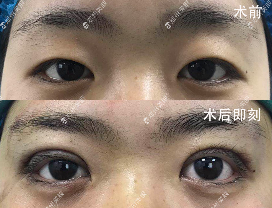 最新雙眼皮手術技巧，創(chuàng)新割雙眼皮方法解析